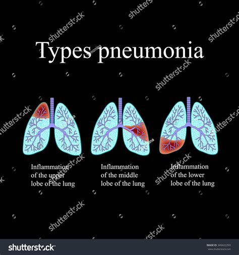 Pneumonia Anatomical Structure Human Lung Type Stock Illustration 349422293