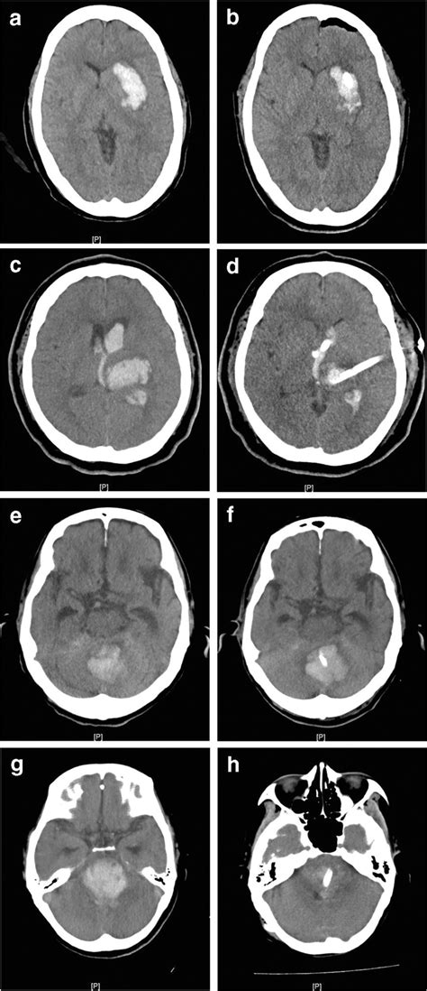 Illustrative Cases Of Stereotactic Intracerebral Hematoma Evacuation