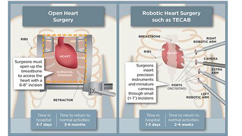 Expert Robotic Heart Surgery Care For Complex Conditions Uchicago