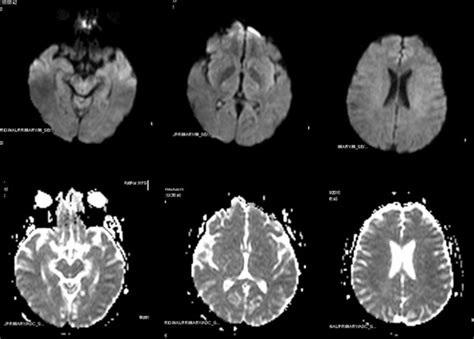 Transient Ischemic Attack Fast Track And Long Term Stroke Risk Role Of