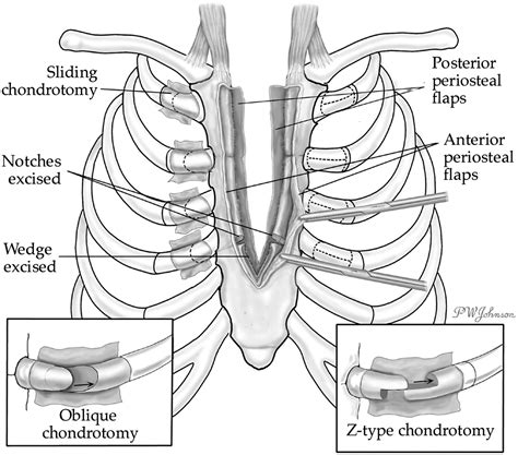 Thoracic Defects Cleft Sternum And Poland Syndrome Thoracic Surgery