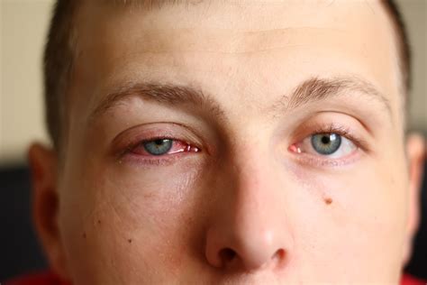 Conjunctivitis In Patients With Atopic Dermatitis Treated With