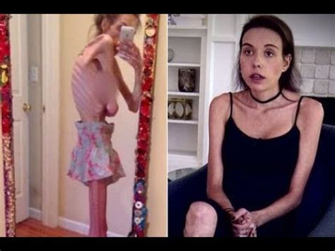 Anorexic Woman Who Weighed Less Than Four Stone Pleads With Tv Doctors To Help Youtube