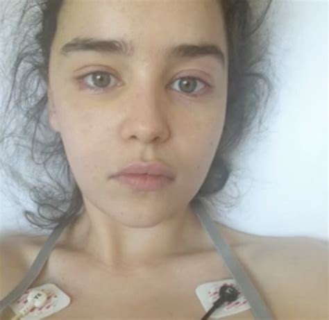 Emilia Clarke Shares Never Before Seen Pics Of Herself After Brain