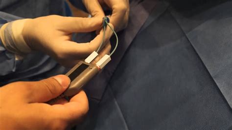 Videos En Cardiología Colocación De Marcapasos Youtube