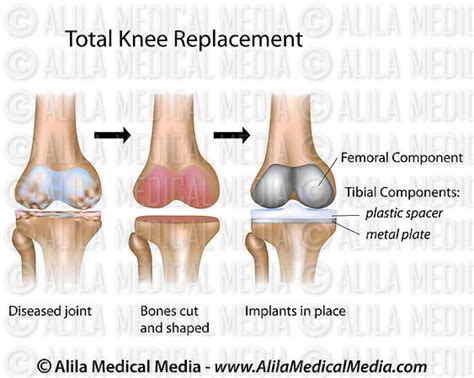 alila medical media total knee replacement surgery diagram medical illustration