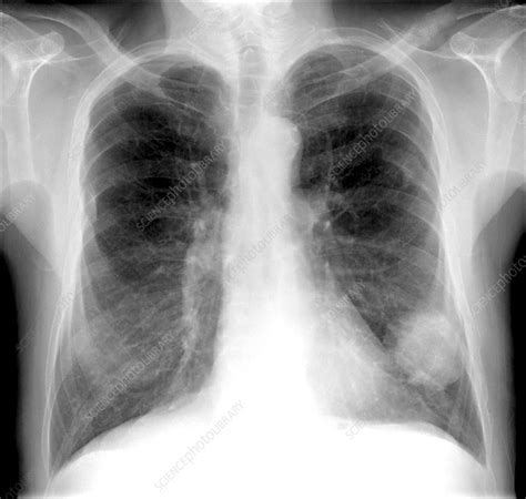 The type of lung cancer you have tells you the type of cell that the cancer started in. Lung cancer, X-ray - Stock Image - C010/3430 - Science ...