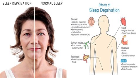 10 Scary Side Effects Of Sleep Deprivation Youtube