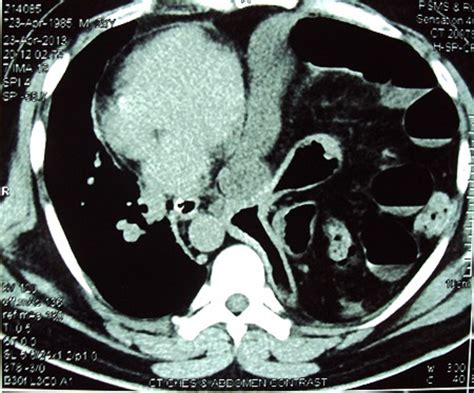 The Case Of Abnormal Abdominal Pain Bmj Case Reports Blog