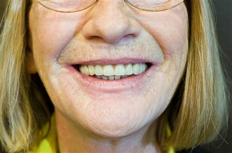 You've told me this story over and over already. Tooth Borne Palate-less Over-dentures utilizing Ceka ...