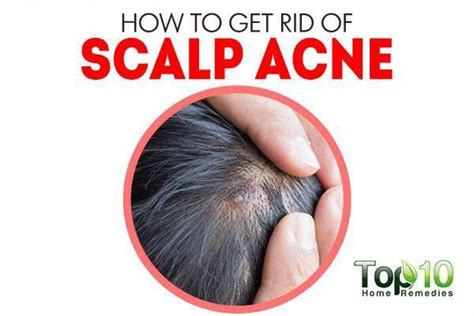Scalp Acne Medical Treatment Home Remedies And Self Care Scalp Acne