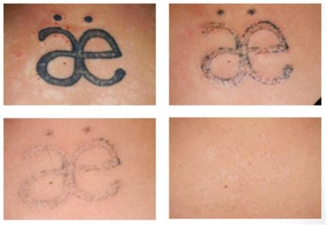 Share More Than 68 Tattoo Laser Removal Best Esthdonghoadian