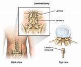 Images of Lumbar Laminotomy Recovery Time