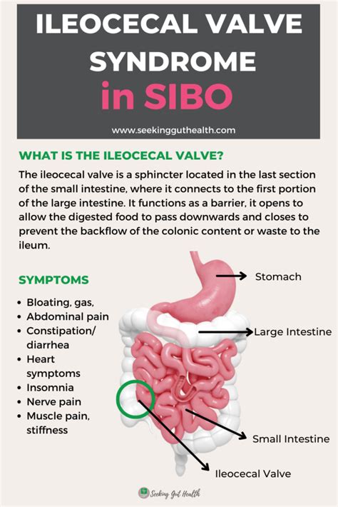 Ileocecal Valve Syndrome In Sibo Seekingguthealth