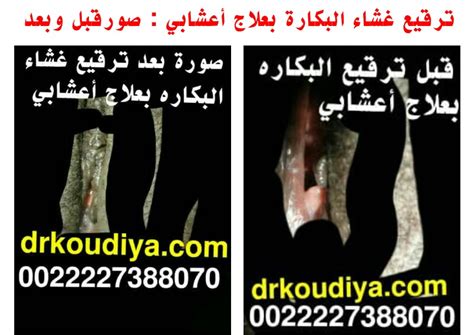 ترقيع غشاء البكارة 0022249165546 طريقة فض غشاء البكارة بالفيديو