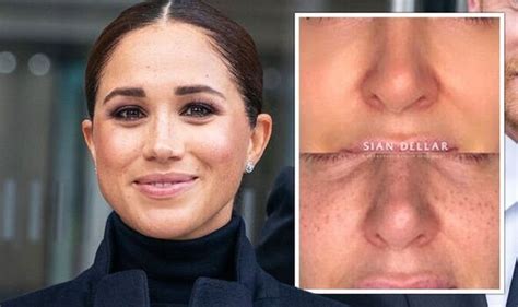 Meghan Markle News Freckle Tattoos Most Requested Treatment Make A Face Look Younger