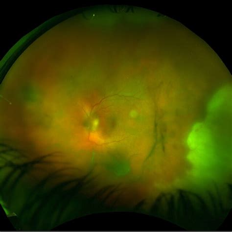 Optomap Fundus Photography Shows Inflammatory Optic Disc Edema And