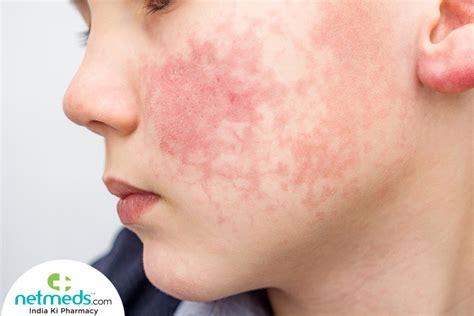 Slapped Cheek Syndrome Causes Symptoms And Treatment