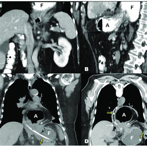Ab Contrast Enhanced Abdominal Ct After Oral Contrast Administration