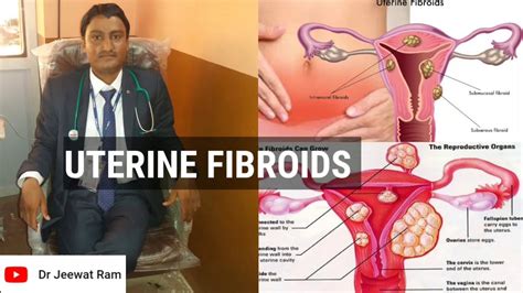 Uterine Fibroids Causes Signs Symptoms Diagnosis And Management Youtube