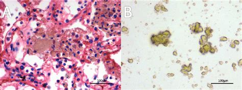 Barium Sulfate Contrast Material In Lung A And Direct Smear B A
