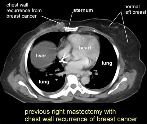 Can Chest Ct Scan Detect Breast Cancer Ct Scan Machine