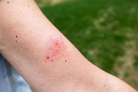 How To Treat Poison Ivy Or Oak Osf Healthcare