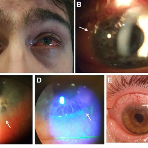 Pdf Ocular Surface Diseases Induced By Dupilumab In Severe Atopic