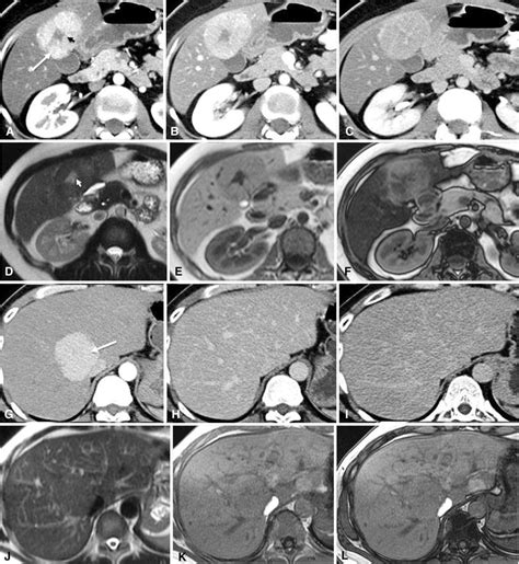 Focal Nodular Hyperplasia Ct Images Top Row And Mri Images Second