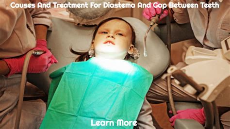 Causes And Treatment For Diastema And Gap Between Teeth Orca Digitals