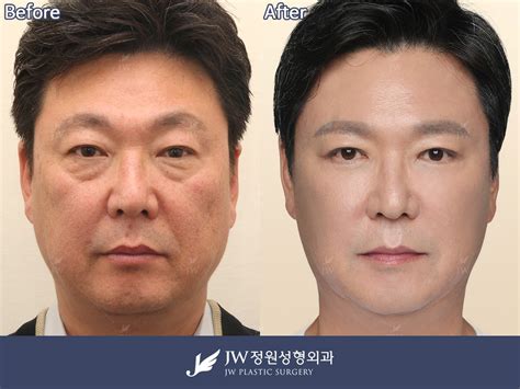 The Price For Male Plastic Surgery In Korea Common Plastic Surgery In