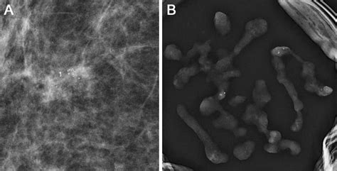 Recall And Outcome Of Screen Detected Microcalcifications During