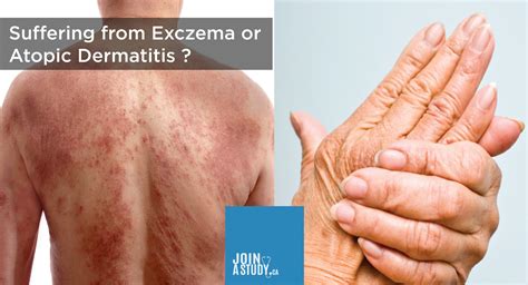 Experiencing From Eczema Or Atopic Dermatitis Joinastudyca
