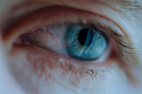 Ocular Rosacea Treatment Symptoms And Causes Michigan Eye Institute
