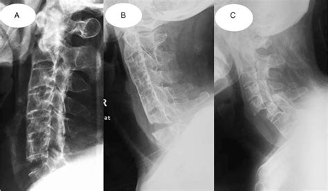 Surgical Therapy Of Cervical Spine Fracture In Patients With Medicine