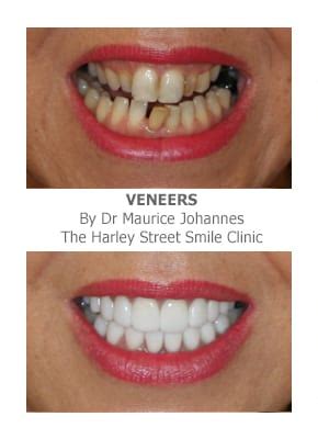 If you're interested in fixing crooked teeth without braces, you might consider treatment with removable clear aligners. Veneers for Crooked Teeth | Harley Street Smile Clinic