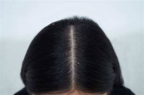 38 Best Images Dandruff Black Hair / 5 Healthy Signs That Your Anti ...