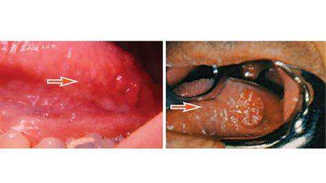 Screening For Oral Cancer Decisions In Dentistry