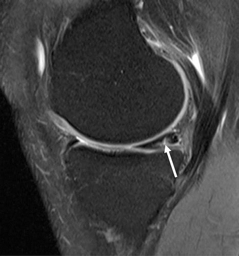 Mri T2 Mapping Of The Knee Providing Synthetic Morphologic Images