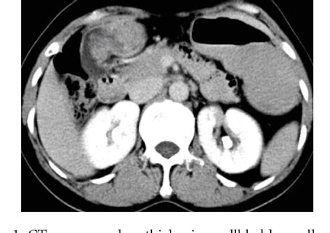 Figure 1 From Gallbladder Tuberculosis Mimicking Gallbladder Carcinoma