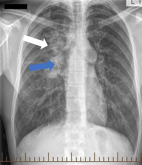 Tuberculosis Chest X Ray Findings