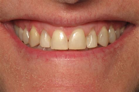 Dental Patient Gallery Before And After Photos Weston Spencer Dds