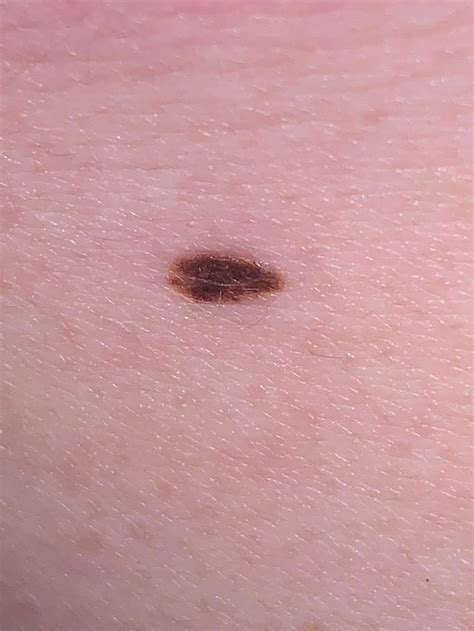 Tiny Black Dot On My Upper Back Is It A Melanoma Or Something Else