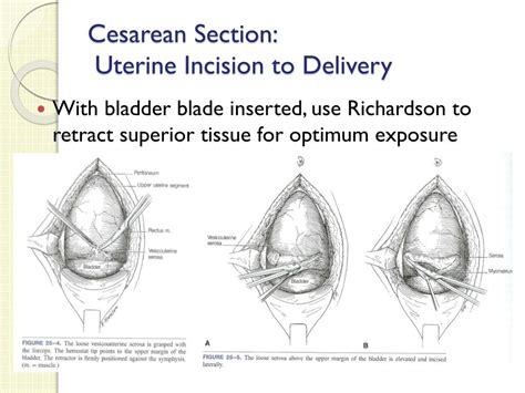 Ppt “youre Going To Suction What” Cesarean Section Basics For Fp Powerpoint Presentation