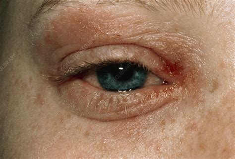 Eczema Around Eye Of A Patient Stock Image M1500159 Science