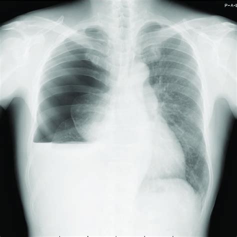 Chest Radiography Shows Right Sided Severe Pneumothorax With Pleural