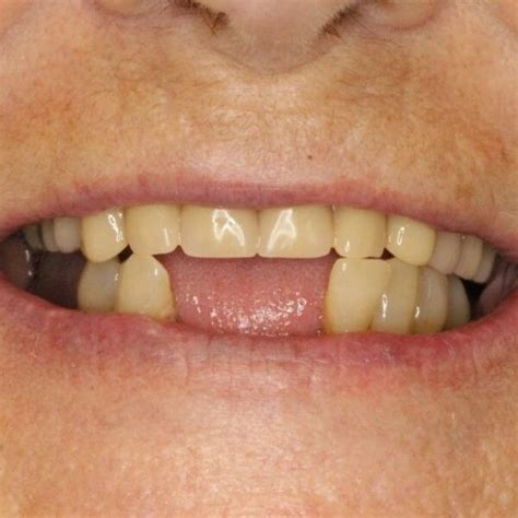 Partial Dentures Front Teeth