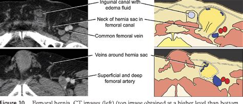Figure 10 From Diagnosis Of Inguinal Region Hernias With Axial Ct The