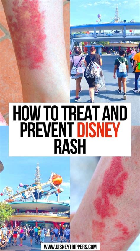 How To Treat And Prevent Disney Rash Artofit