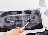 Dental Implants Palm Beach Gardens Fl